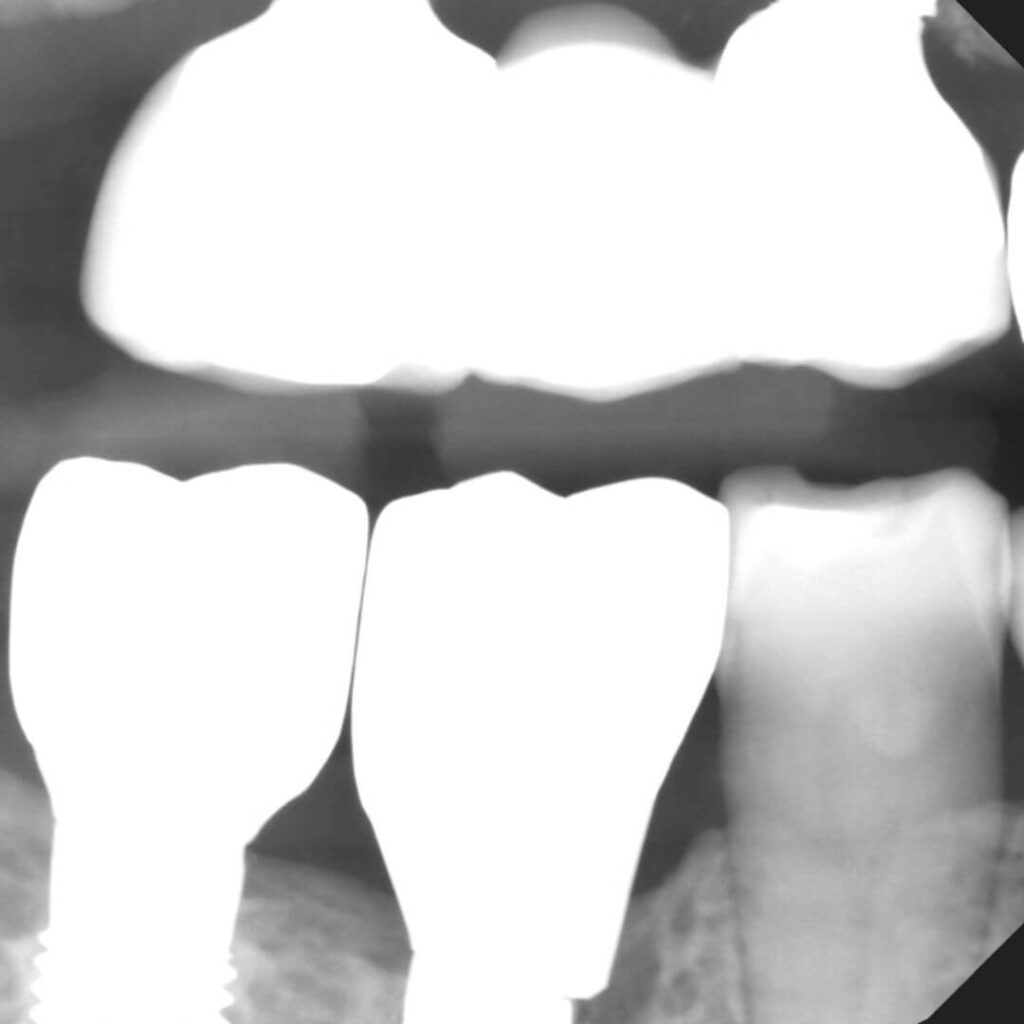 Dental X-ray of Implants